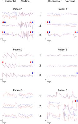 A 6-month trial of memantine for nystagmus and associated phenomena in oculopalatal tremor